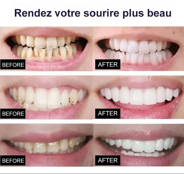 Pack(2 boites) Blanchiment instantané des dents pour Hommes et Femmes